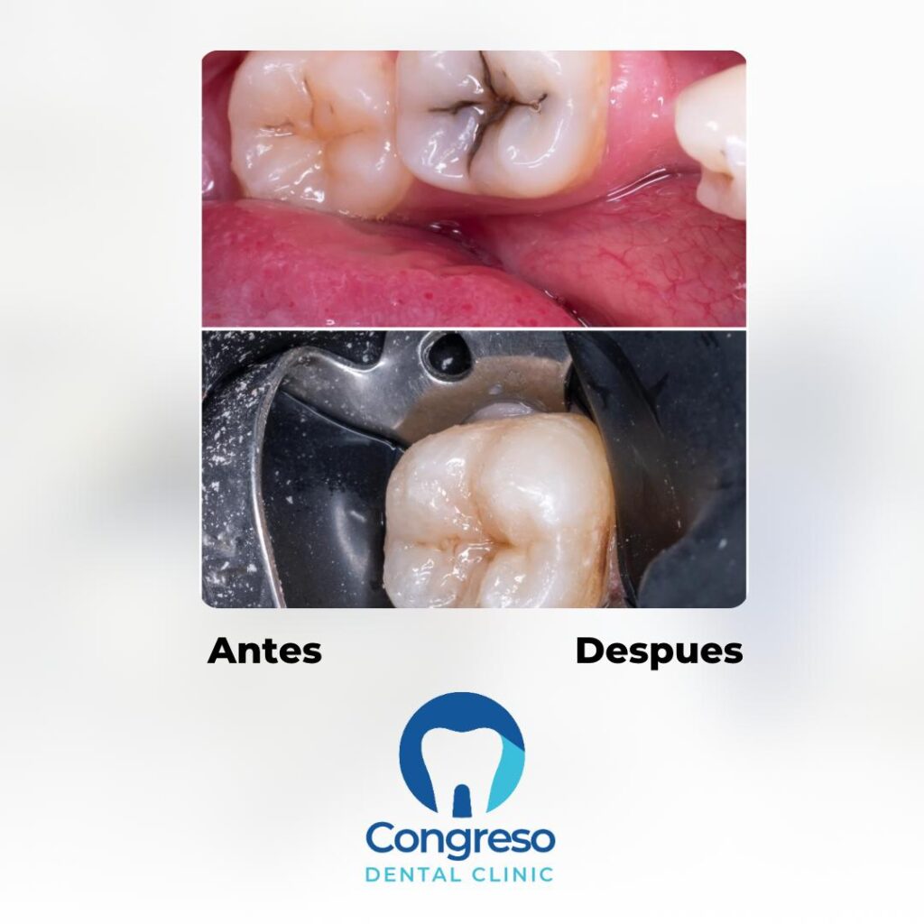 Tratamiento de conducto en molar antes y después - Caso real con dique de goma aislación - Congreso Dental Clinic Buenos Aires