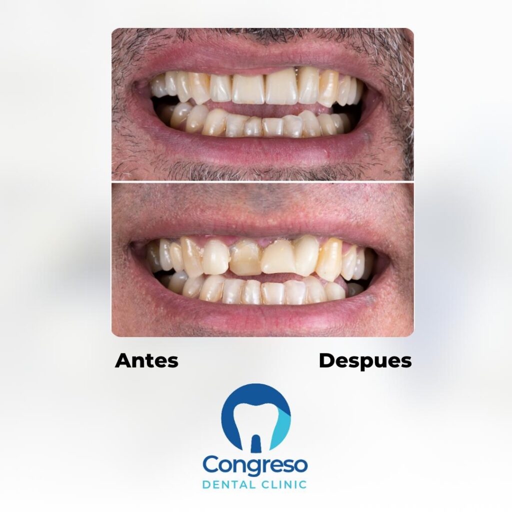 Endodoncia en molar posterior antes y después del tratamiento - Vista clínica lateral - Especialistas Congreso Dental