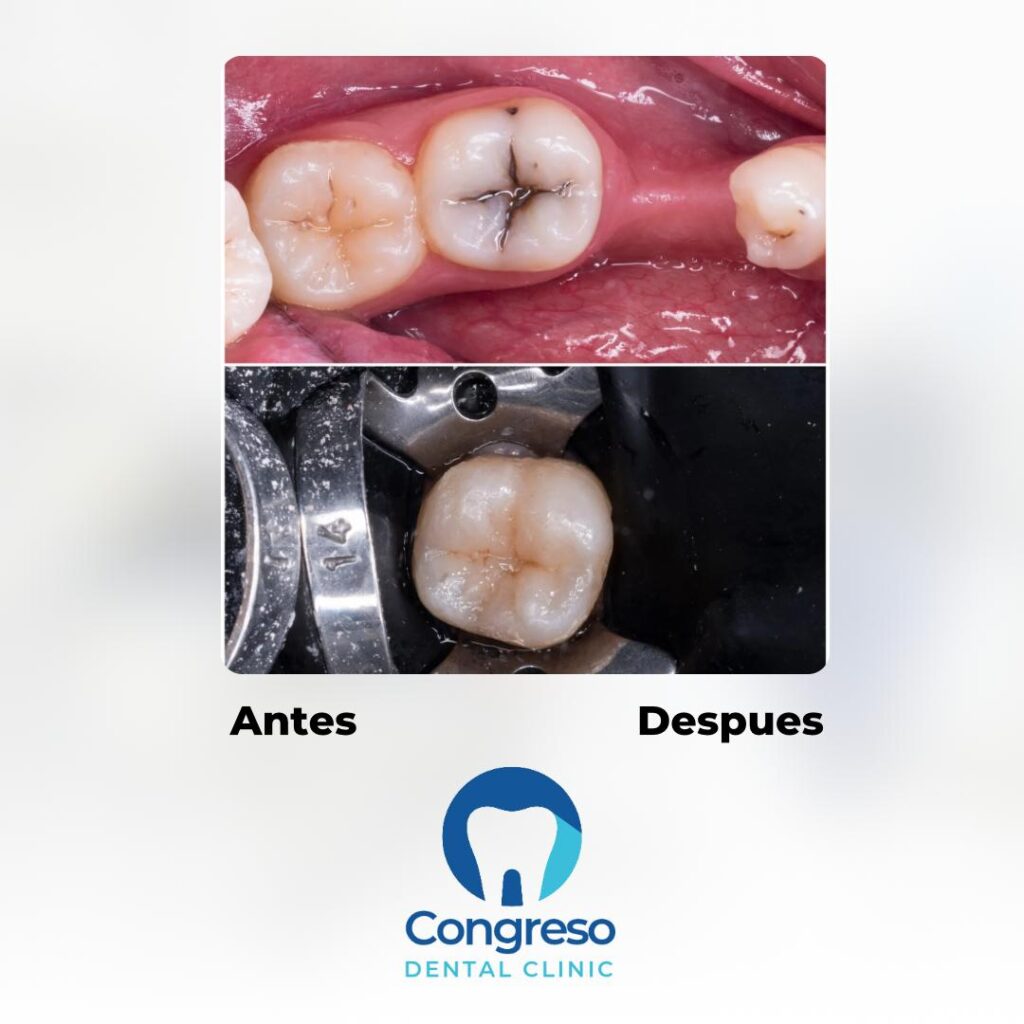 endodoncia dental antes y después de tratamiento de conducto - Reparación ósea completa periapical - Odontologia Congreso Dental especialistas en caba