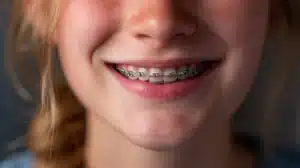Brackets para corregir mordida cruzada en niños y adolescentes – Congreso Dental