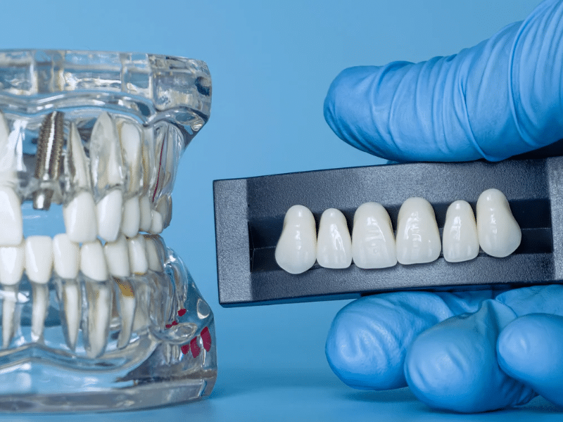 Coronas dentales de porcelana en CABA para rehabilitación oral estética
