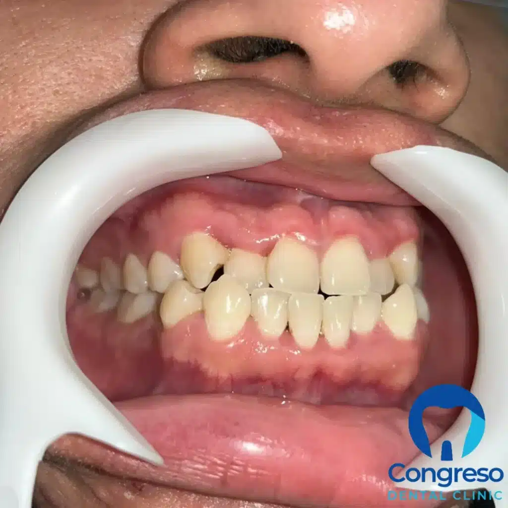 Mordida cruzada antes del tratamiento: apiñamiento dental y maloclusión vista frontal, caso 1