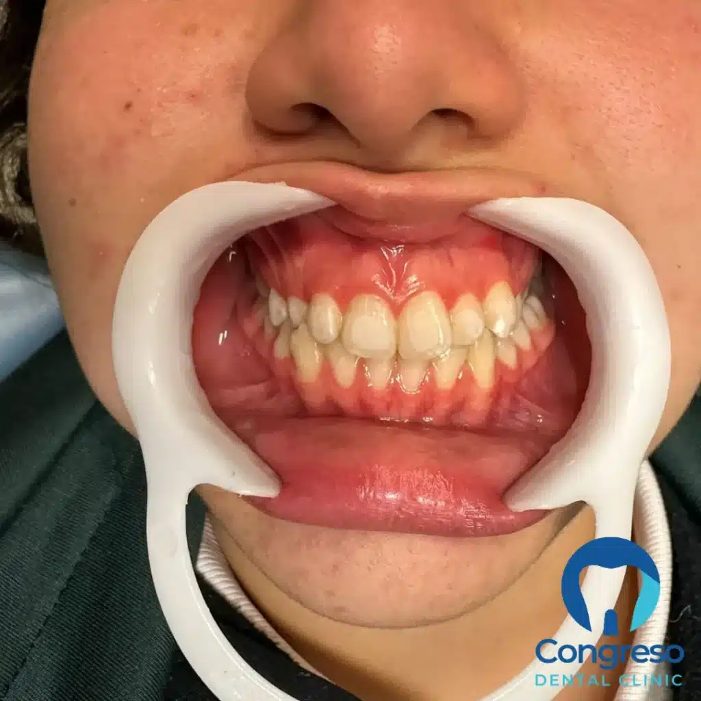 Mordida cruzada después del tratamiento: alineación dental corregida, resultado frontal caso 2