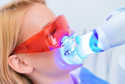 Blanqueamiento-Dental-1.jpg