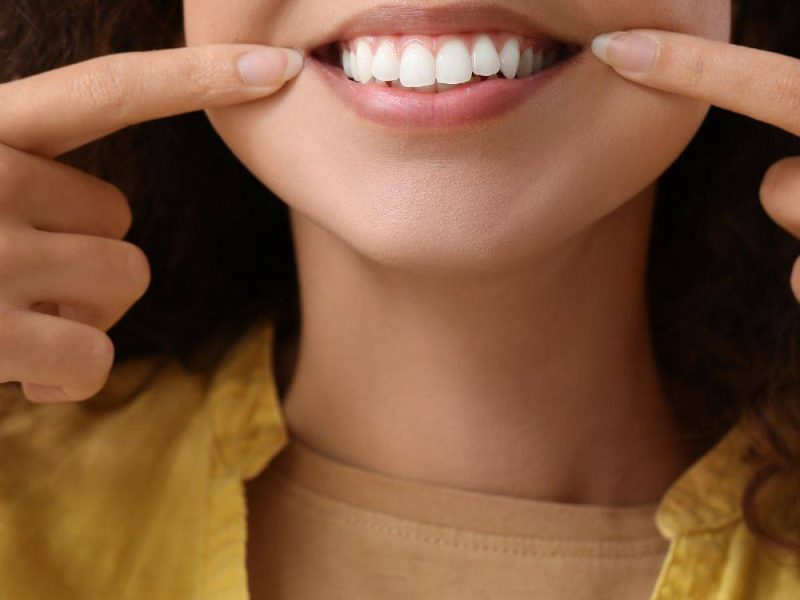 Carillas-dentales-1-1.jpg