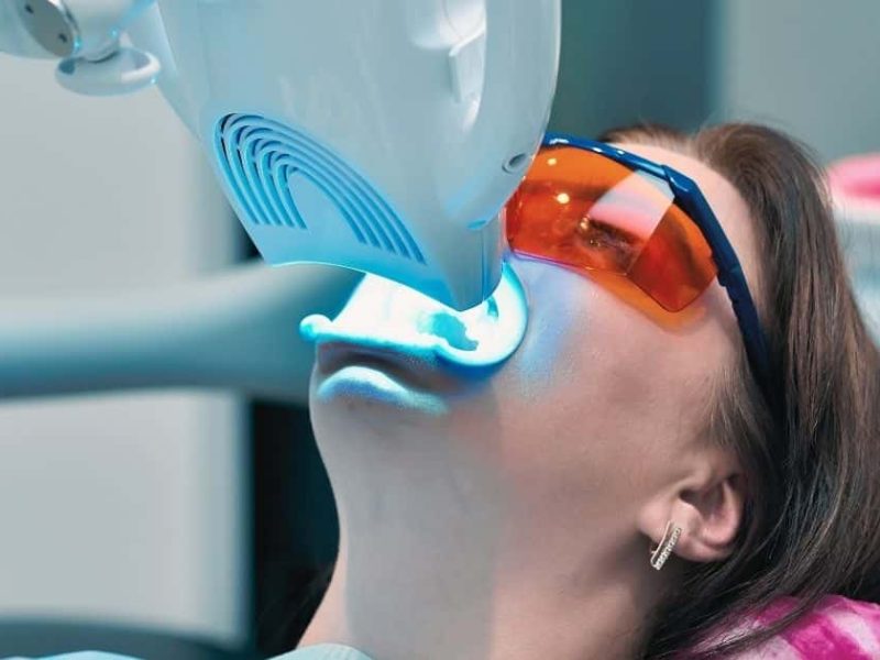 blanqueamiento-dental-caba