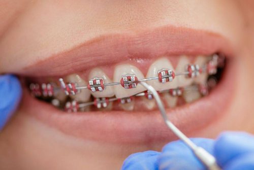 ortodoncia-de-brackets-4.jpg