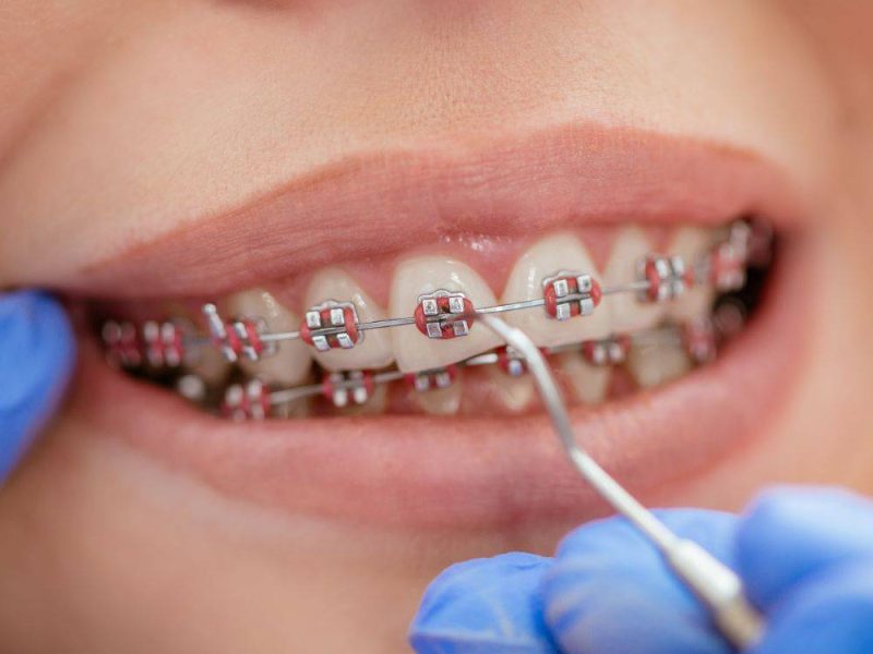 ortodoncia-de-brackets-4.jpg